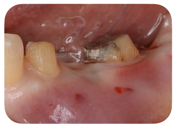歯ぐきの少ない部位に対する歯肉移植症例