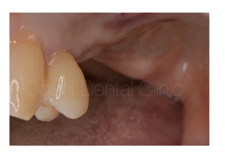 奥歯3本欠損に対するインプラントの選択肢