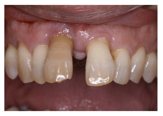 重度歯周病のために前歯を抜歯し、骨造成を併用してブリッジ修復を行った症例
