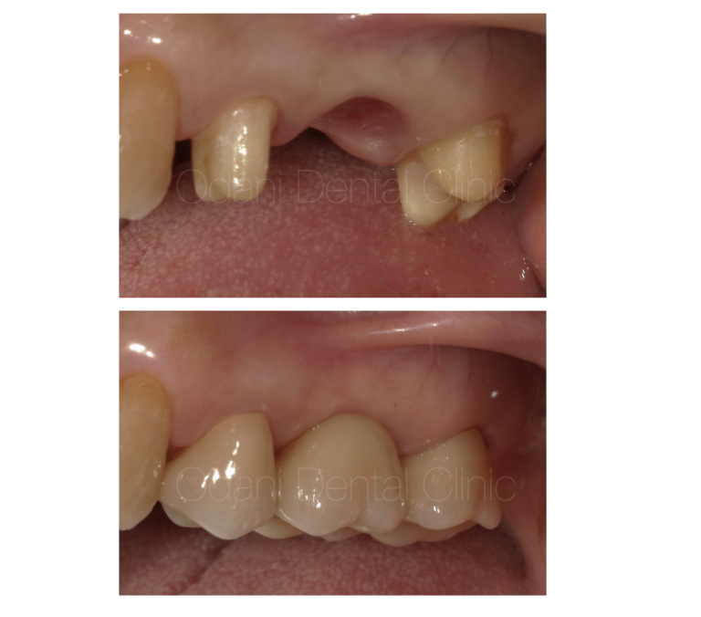 両隣の歯を削るブリッジ治療は良くない治療？？