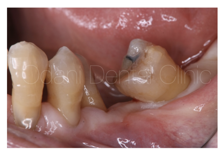 インプラント治療と「歯の位置」