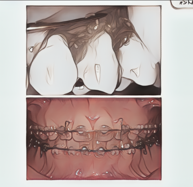 歯並び×歯周病の問題がある場合の歯周矯正治療