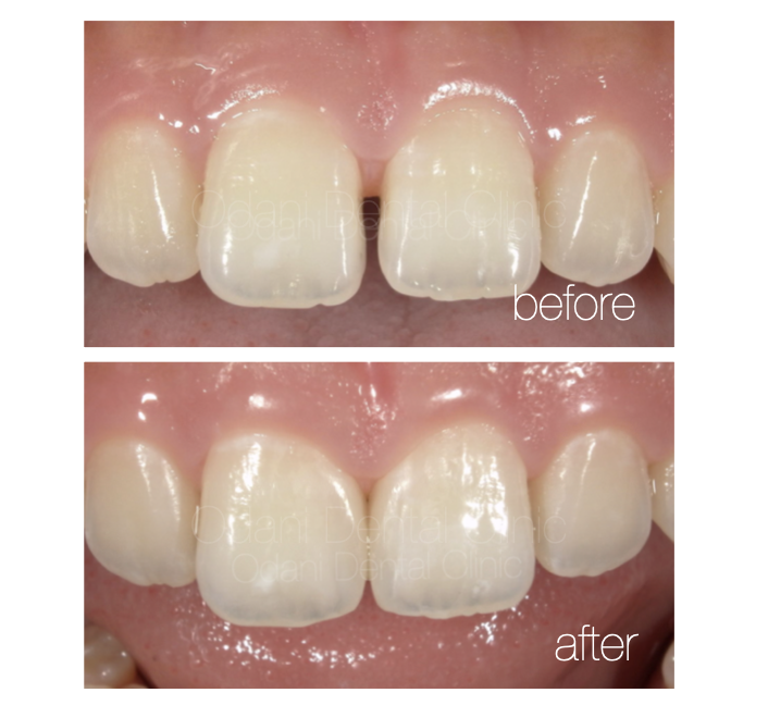 すきっ歯の治療／ダイレクトボンディング