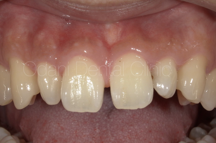 「すきっ歯」を治療！ダイレクトボンディング修復