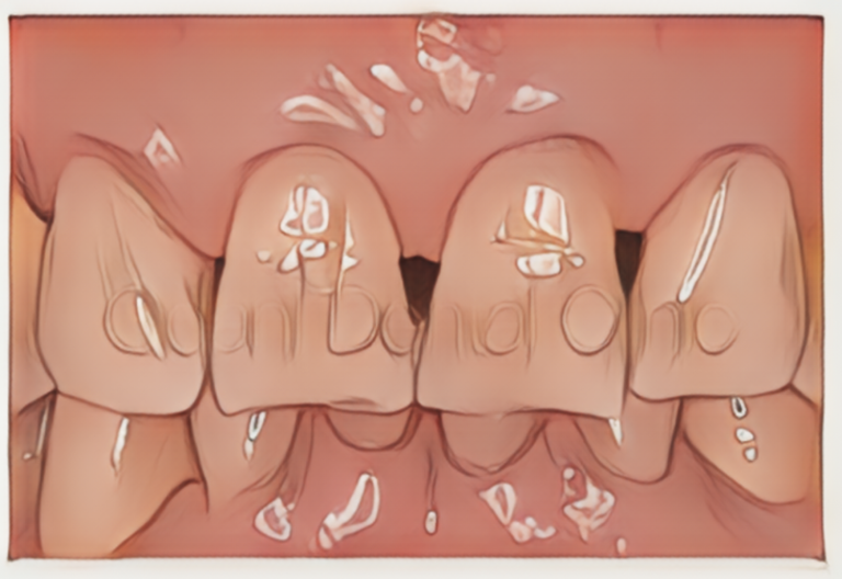 歯と歯の隙間「ブラックトライアングル」の改善
