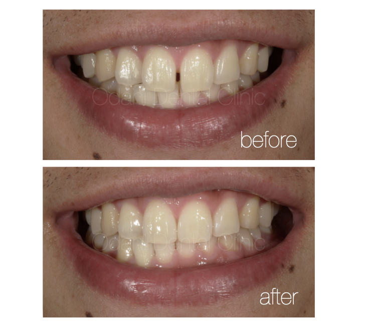 「すきっ歯」を治療！ダイレクトボンディング修復