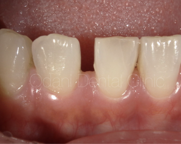 「すきっ歯」の改善