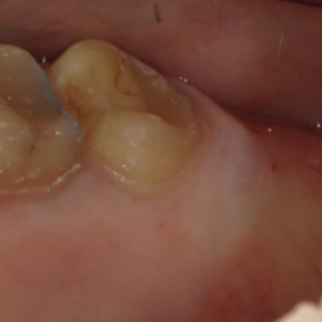 短い歯を長くする「歯冠長延長術」
