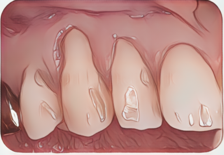 歯ぐきがやせた歯肉退縮部位への歯肉移植症例