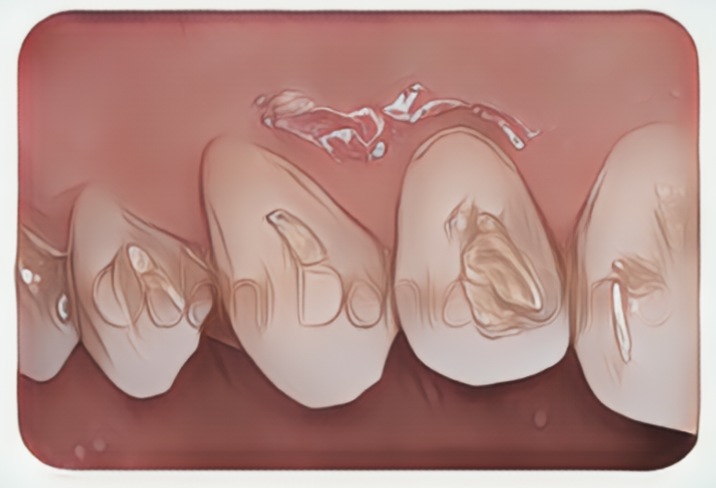 歯ぐきがやせて水が染みてきた部位への歯肉移植症例