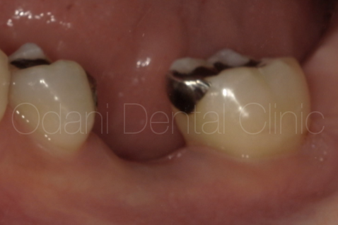 骨造成を伴う奥歯のインプラント治療