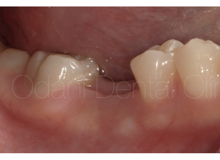 奥歯に対するインプラント治療