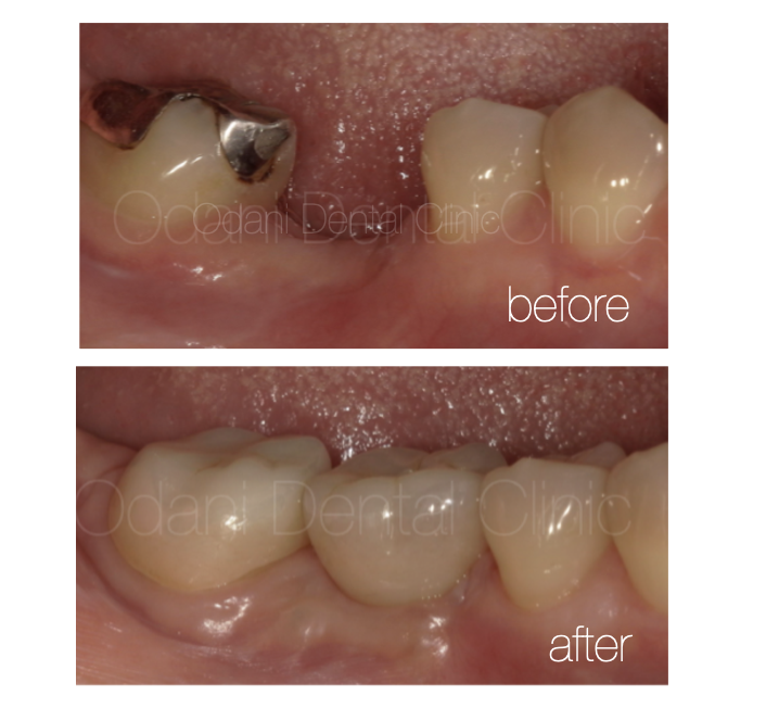 歯と骨を失ったときのインプラント治療