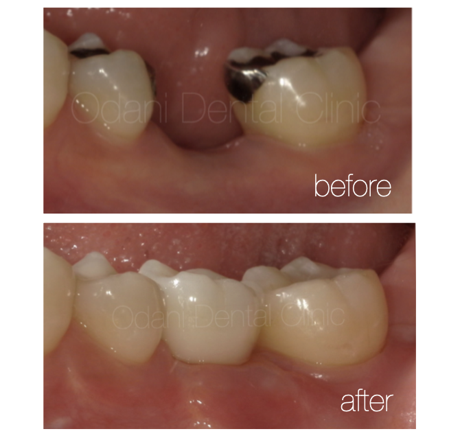 骨造成を伴う奥歯のインプラント治療