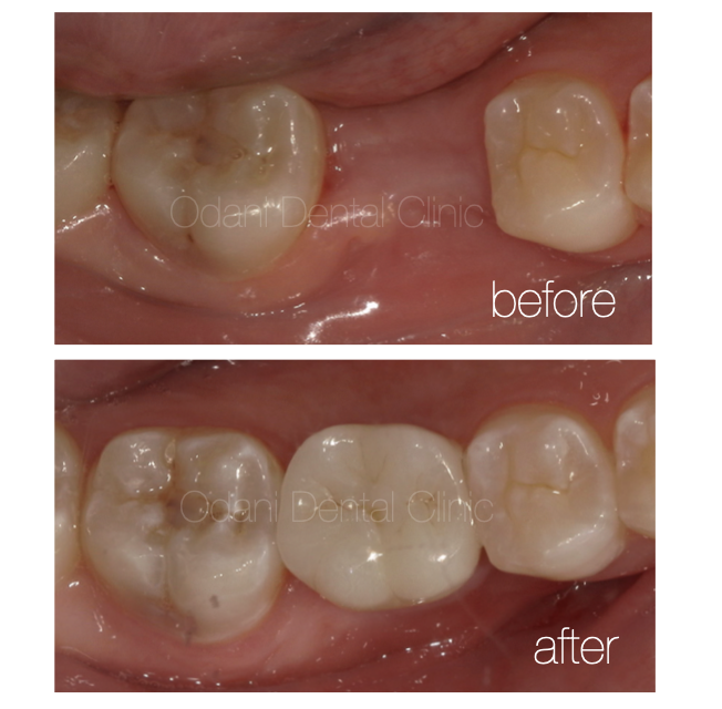 奥歯に対するインプラント治療