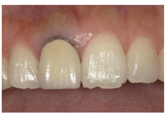 歯ぐきの奥の虫歯を伴った前歯のかぶせ治療