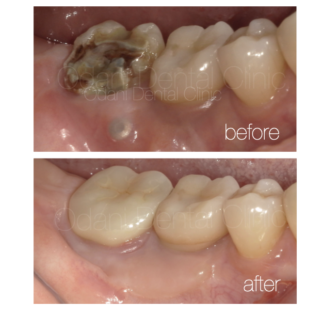 歯周外科処置を用いたインプラント周囲の歯ぐきの再生