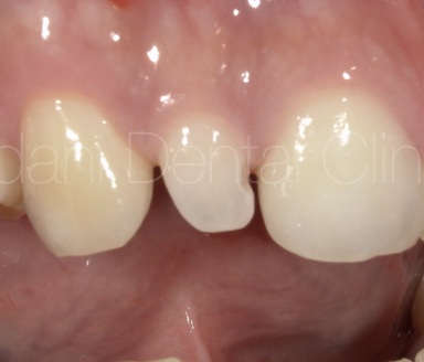 矮小歯（小さな歯）に対する削る量の少ないラミネートベニアというセラミック治療法