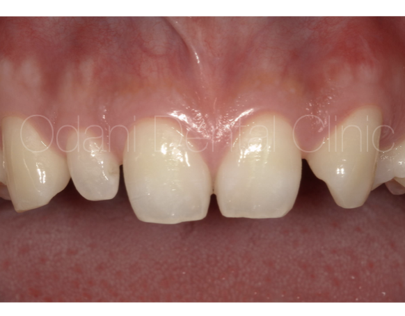 すきっ歯に対して「ラミネートベニア」と「ダイレクトボンディング」を併用した症例