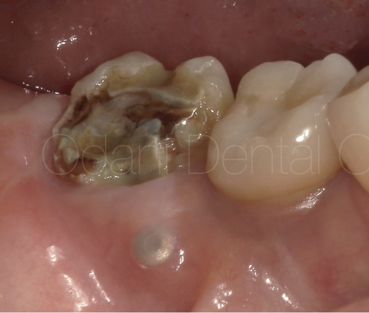 インプラント周囲の歯ぐきの再生