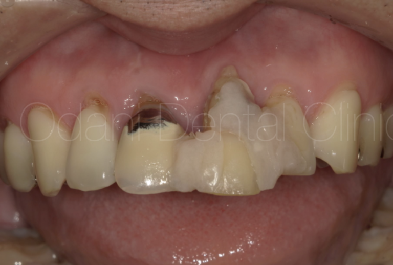 骨造成を用いた歯ぐきのヘコみの改善（歯槽堤増大術）