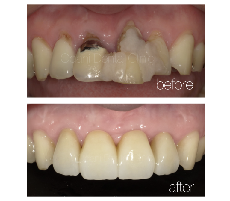 骨造成を用いた歯ぐきのヘコみの改善（歯槽堤増大術）