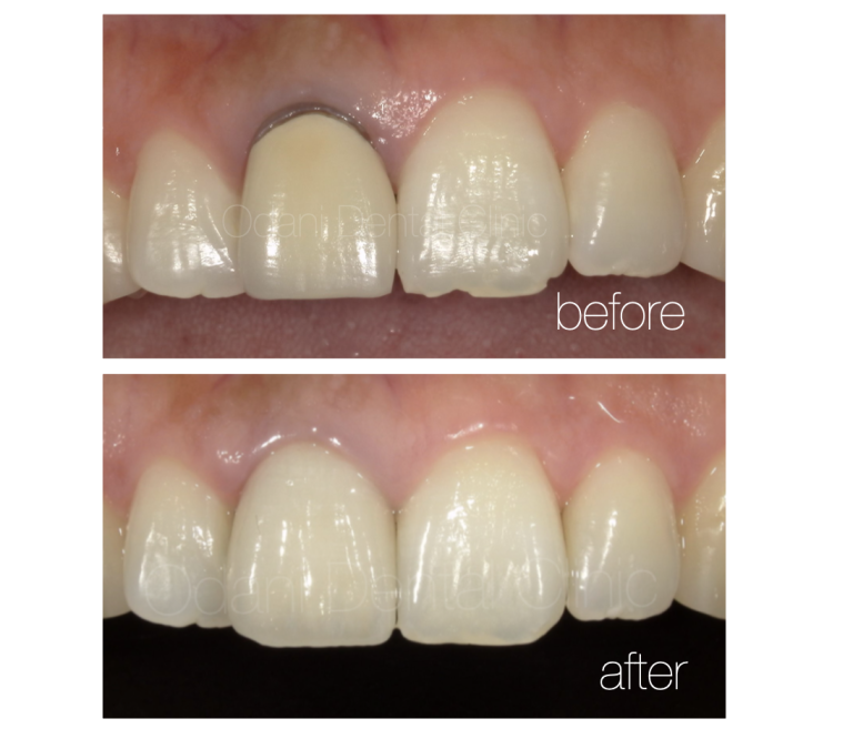 歯ぐきの奥の虫歯を伴った前歯のかぶせ治療