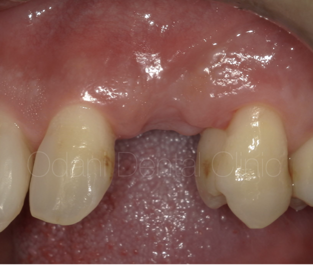 前歯の領域へのインプラント治療