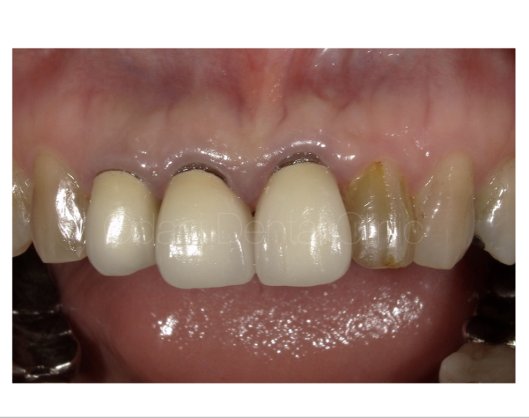 「抜歯窩保存術」を併用して前歯を抜歯し、ブリッジ治療を行なった症例