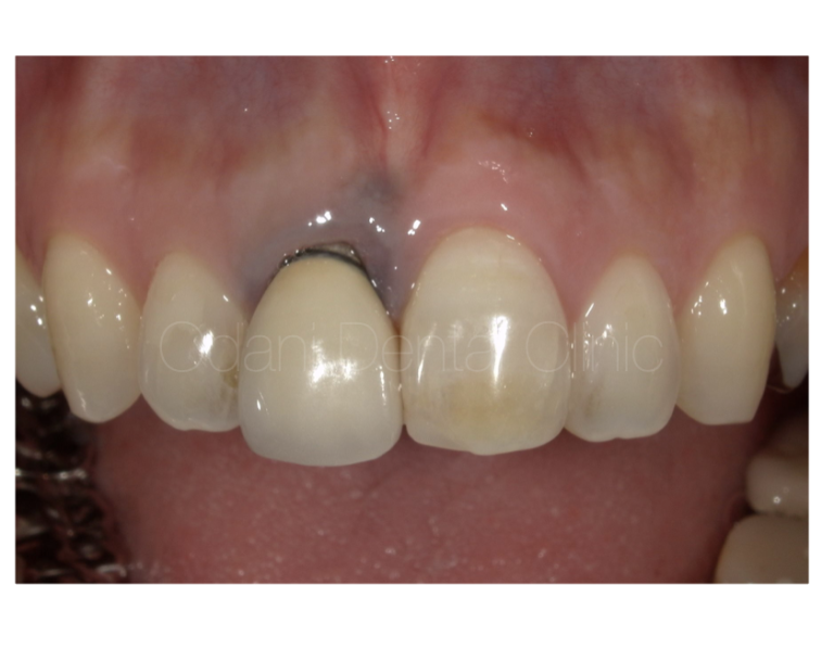 歯周外科処置を用いてメタルタトゥー（歯ぐきの黒ずみ）を除去して、セラミック修復を行なった症例