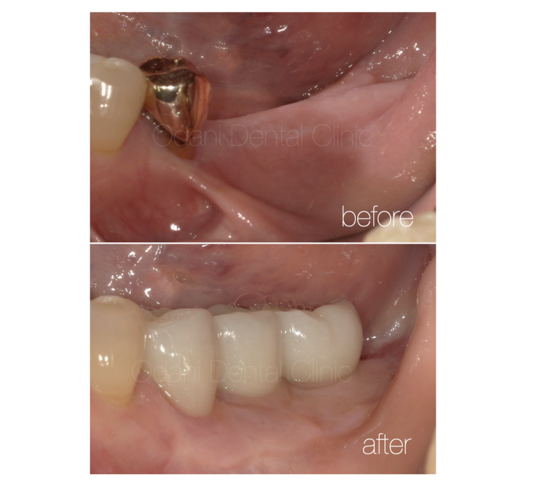 インプラント治療二次手術時における「歯ぐき」の再生オプション　〜遊離歯肉移植術〜