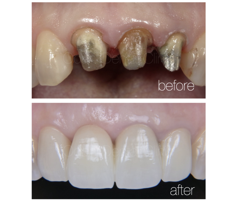 抜歯時に併用する治療オプション「抜歯窩保存術（Ridge Preservation,Socket Preservation）」