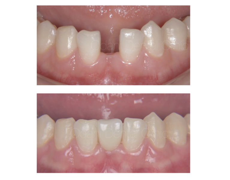 削る量が少ない！「接着ブリッジ」症例