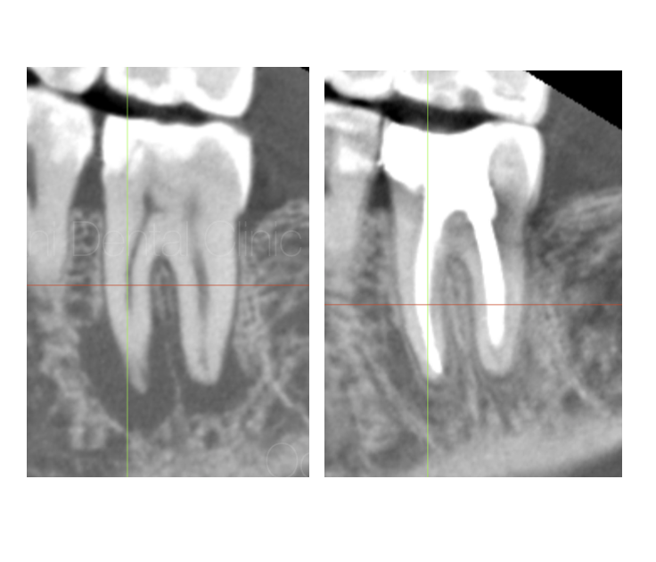 歯髄壊死して広範囲の骨吸収を生じていたため、感染根管治療を行った症例