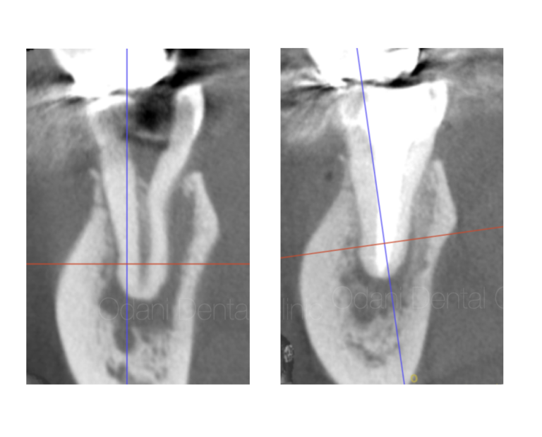 歯髄壊死して広範囲の骨吸収とマヒを生じ、感染根管治療を行った症例