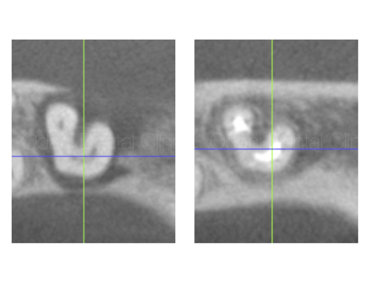 根管治療により抜歯が回避できた症例　3年経過