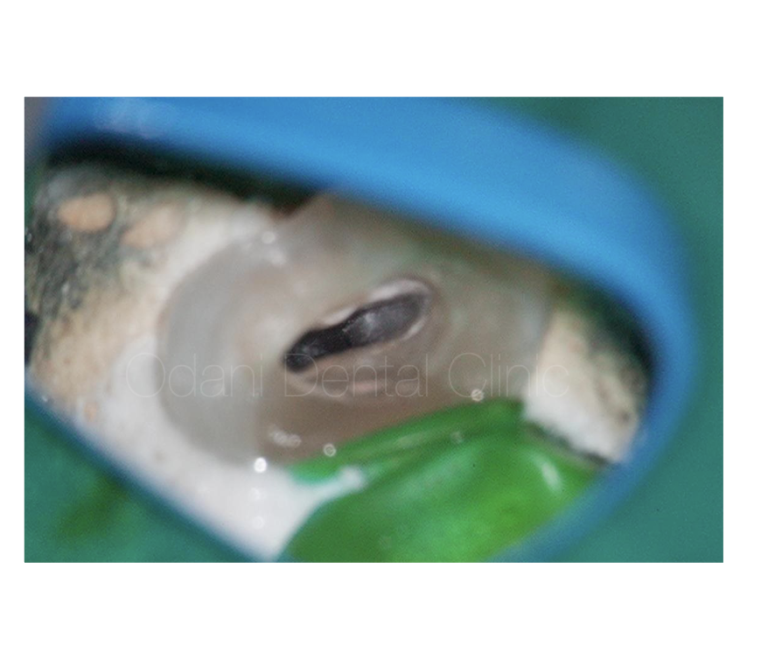 他院にて根管治療後に痛みが引かず、再根管治療を行った症例