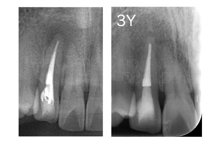 前歯の感染根管治療（再治療）