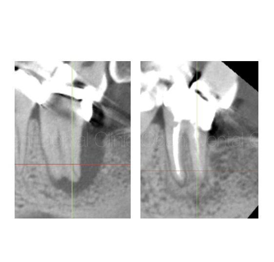 抜歯を覚悟したが、根管治療により歯が保存できた症例　2年経過