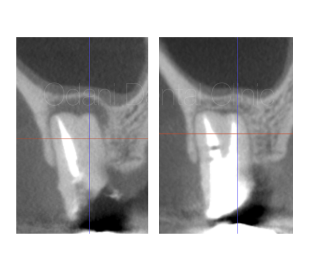 CTとマイクロスコープにより隠れた根管を発見し、根管治療を行なったことで骨の吸収が治癒した症例　1年経過