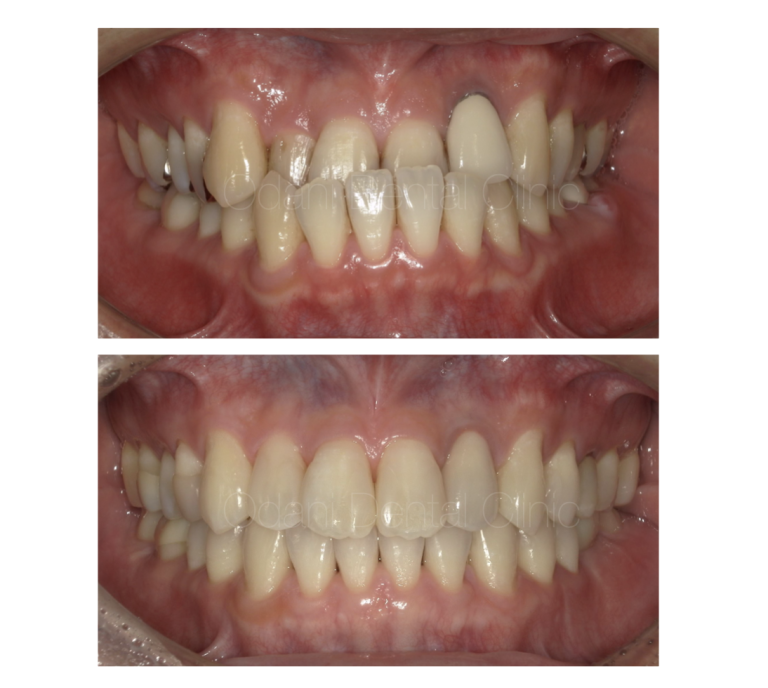 より良いかみ合わせに仕上げるための矯正治療＋α