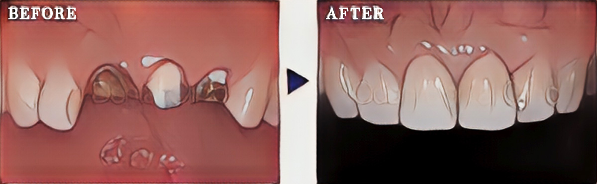 歯ぐきを整え、セラミック修復を行った症例