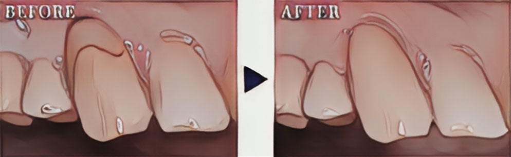 歯と歯ぐきとの際の虫歯