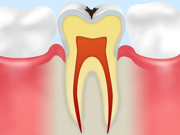 C1：エナメル質にとどまっている虫歯