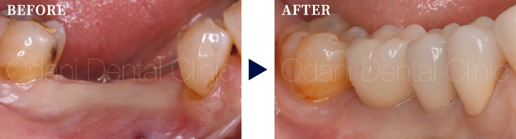 下の奥歯２本のインプラント治療