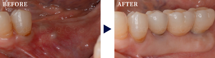 歯ぐきの少ない部位に対する歯肉移植症例