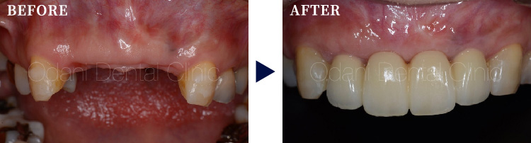 前歯に対するインプラントブリッジ治療
