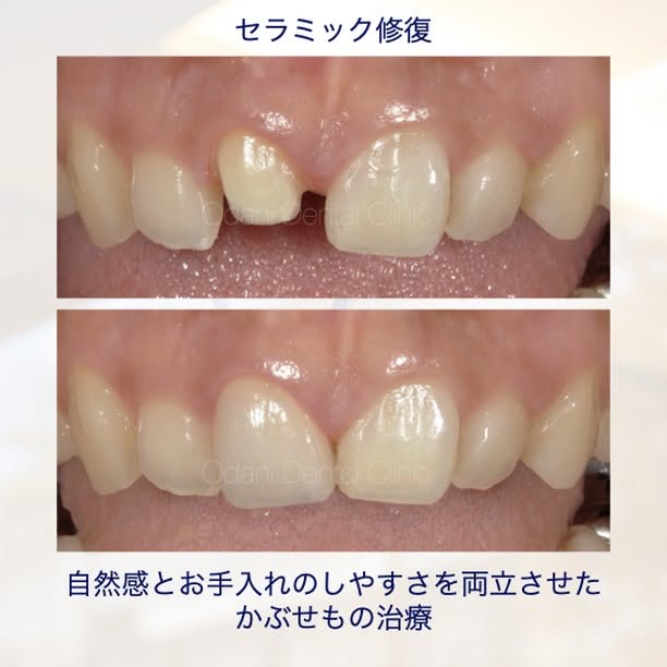 セラミック修復