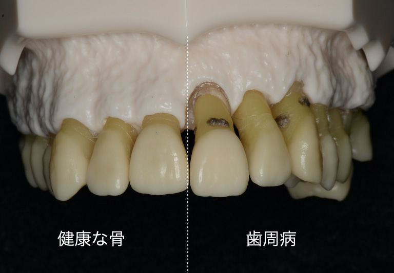 健康な骨の状態と歯周病の状態の比較