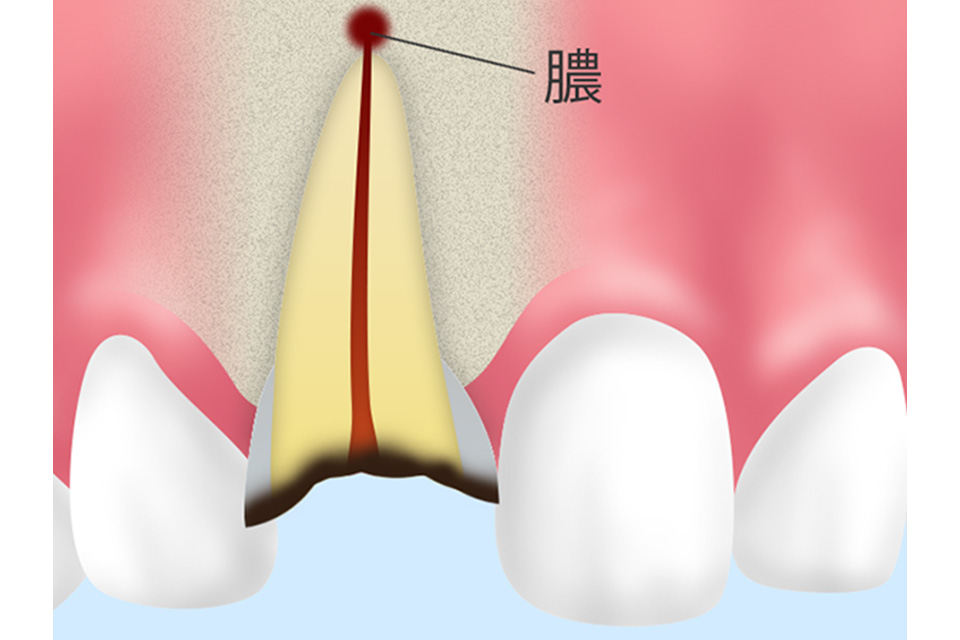 歯根端切除術